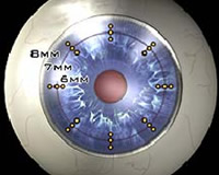 Radiofrequency Probe Diagram 