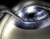 Keratoplasty Procedure Diagram