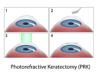 PRK Procedure Diagram