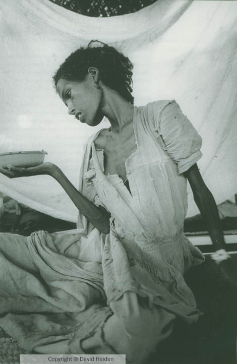 Hospital patient with malnutrition and pneumonia. FAU 3 refugee camp, March 1985. In Dr. Heiden's "Dust to Dust"