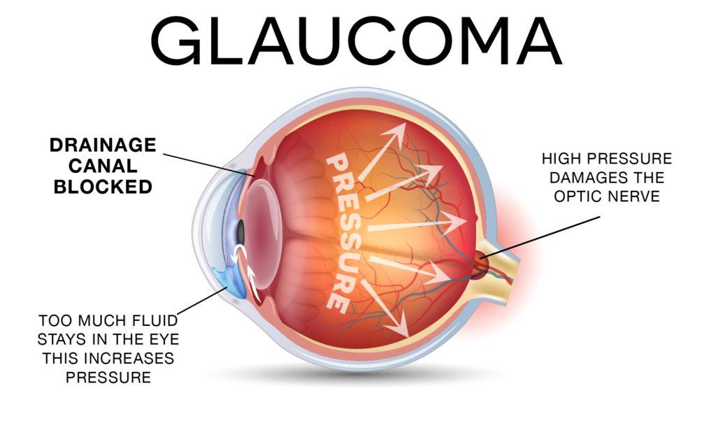 Glaucoma Graph