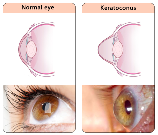 Keratoconus diagram