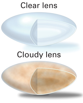 Clear lens versus an eye with cataracts
