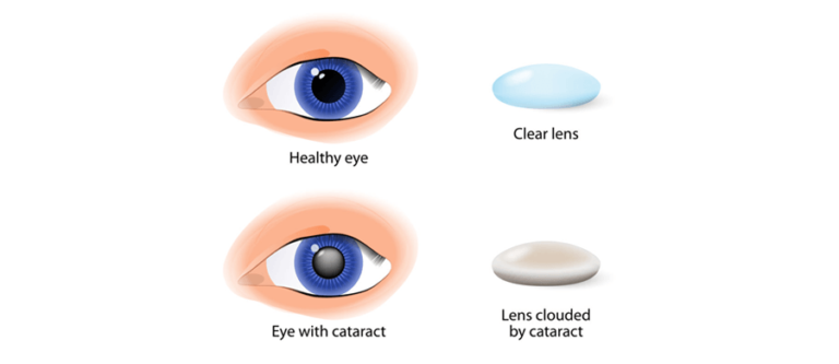 Cataract Surgery: Which is the better lens, Multifocal or Monofocal - Johnson And Johnson Cataract Lens Review