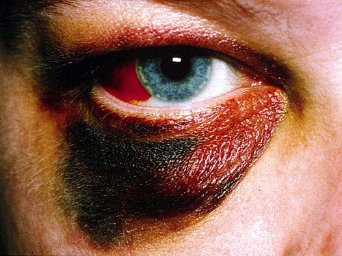 Example of Orbital Trauma