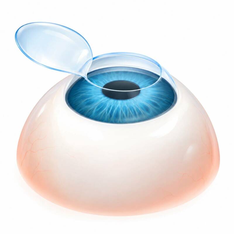 LASIK Illustration