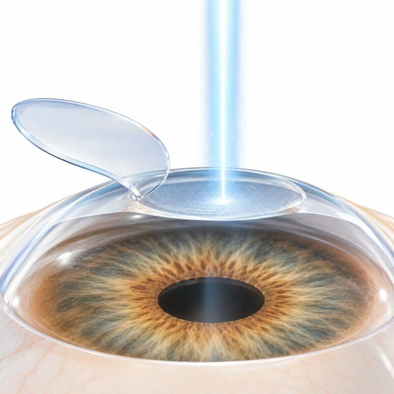 LASIK Surgery Illustration