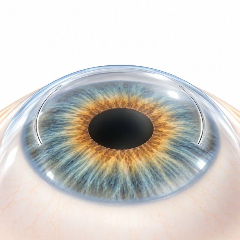 Limbal Relaxing Incisions